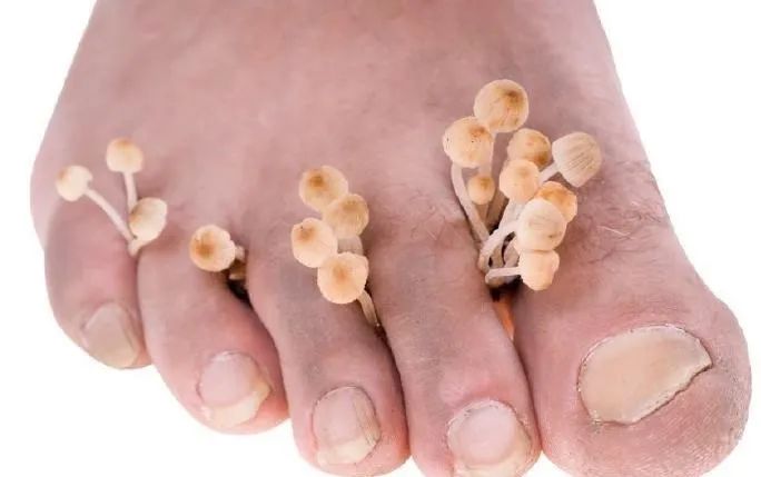夏天容易犯腳氣，5個(gè)妙招交給你！