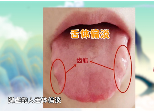 手上一個(gè)部位，看出你是否有溼氣！按摩一個(gè)穴位，健脾祛溼