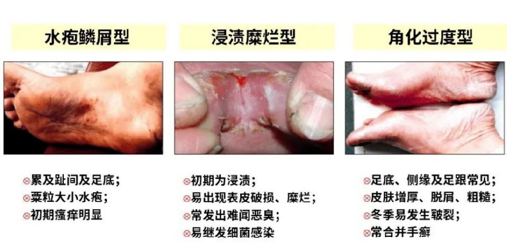 足癬應(yīng)該怎麼預防？