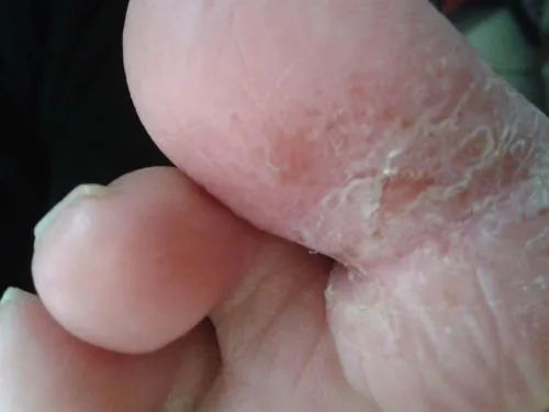 夏季足癬高發(fā)，5類(lèi)人群要注意預防！