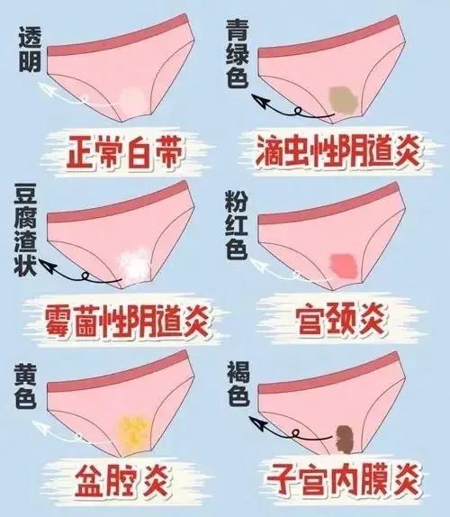常見(jiàn)的婦科炎症有哪些？